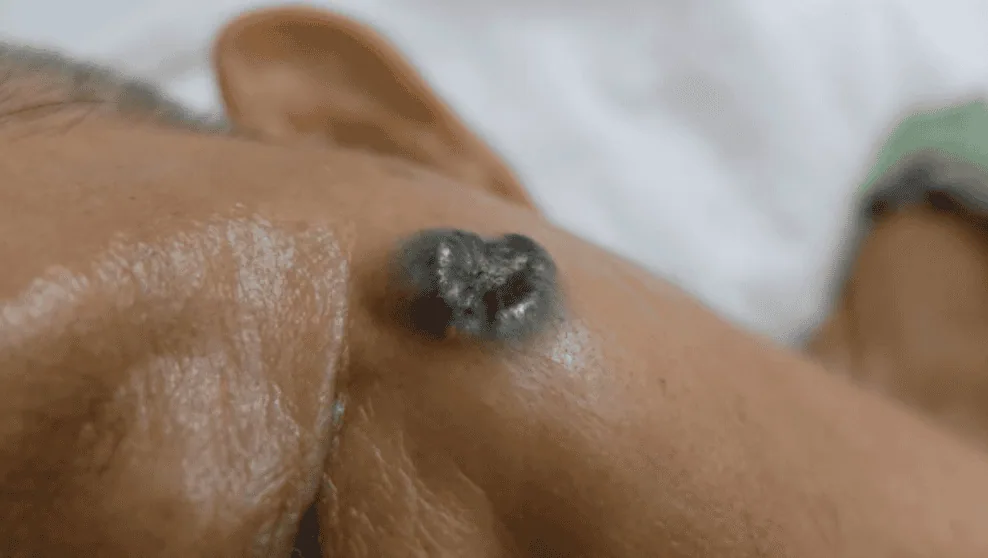 Basal Cell Carcinoma: The Most Common – and Most Treatable – Skin Cancer