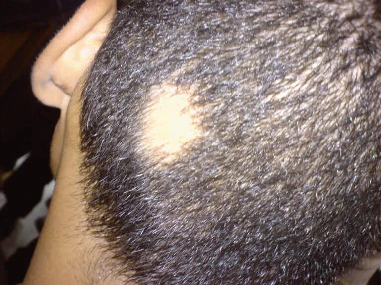 Alopecia Areata in Bridgewater, NJ | PS Dermatology and Surgery