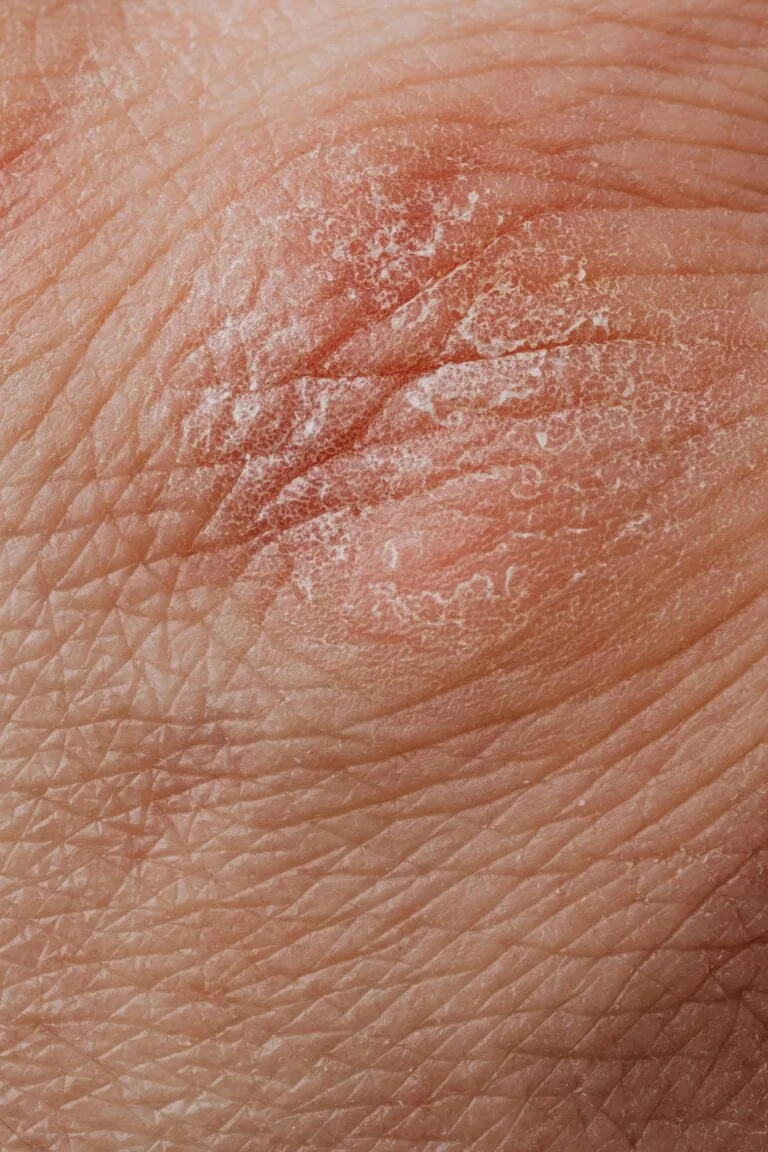 Atopic Dermatitis - Pediatric | PS Dermatology and Surgery