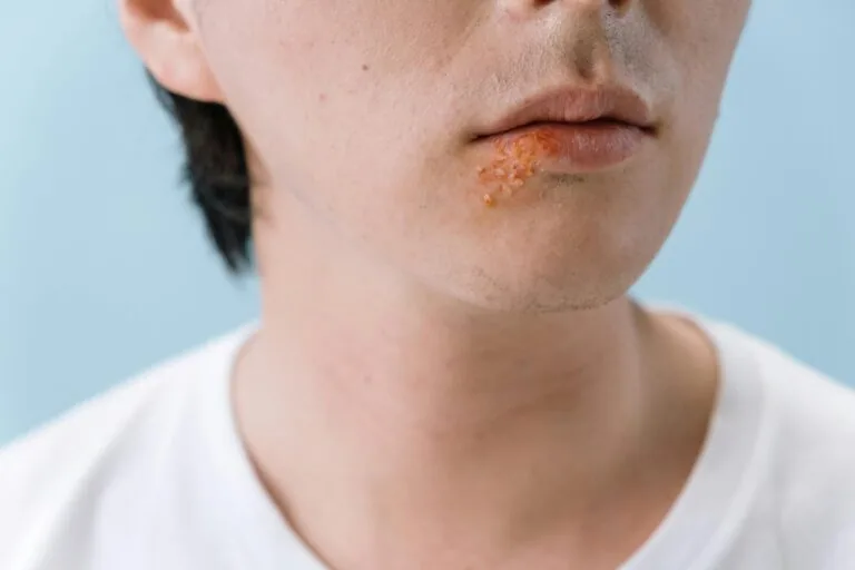 Herpes Simplex Virus in Bridgewater, NJ | PS Dermatology and Surgery
