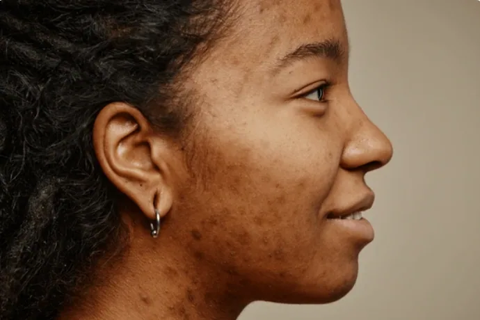 scar treatment
