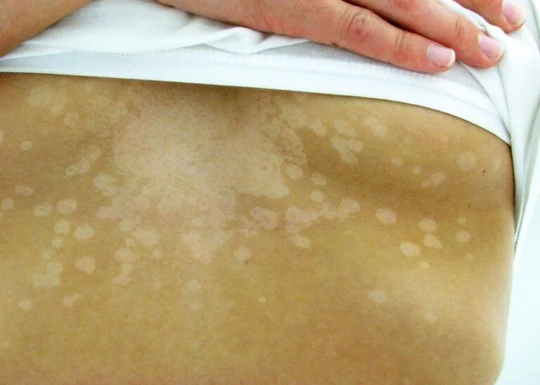 Tinea Versicolor in Bridgewater, NJ | PS Dermatology and Surgery