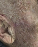 The same area six months after Mohs surgery, healed with no visible scarring