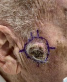 Skin cancer behind the ear outlined for Mohs surgery