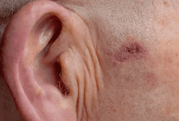 Basal Cell Carcinoma: The Most Common – and Most Treatable – Skin Cancer